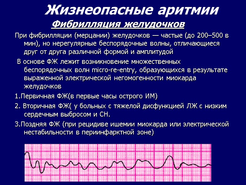Фибрилляция желудочков При фибрилляции (мерцании) желудочков — частые (до 200–500 в мин), но нерегулярные Фибрилляция желудочков При фибрилляции (мерцании) желудочков — частые (до 200–500 в мин), но нерегулярные
